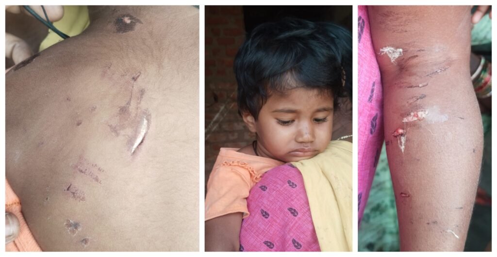 సూరంపల్లిలో వీధి కుక్కల దాడి-3 ఏళ్లచిన్నారి తీవ్రంగా గాయపడి ఆసుపత్రికి తరలింపు