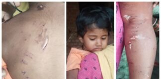 సూరంపల్లిలో వీధి కుక్కల దాడి-3 ఏళ్లచిన్నారి తీవ్రంగా గాయపడి ఆసుపత్రికి తరలింపు